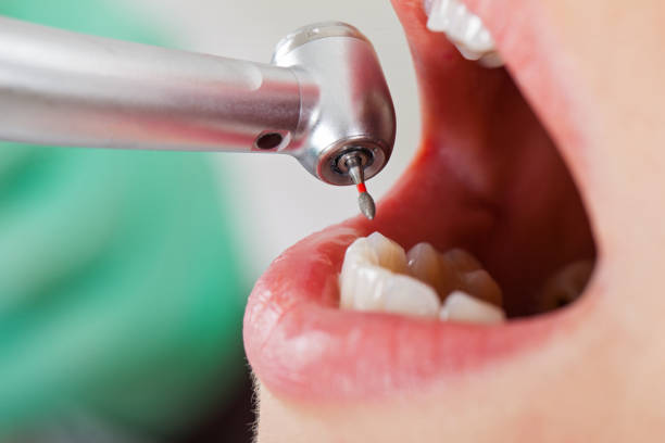 Best Emergency Tooth Extraction in Brooklyn, IN